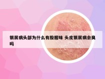 银屑病头部为什么有股腥味 头皮银屑病会臭吗