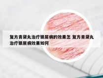 复方青黛丸治疗银屑病的效果怎 复方青黛丸治疗银屑病效果如何