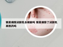 银屑病擦润肤乳会缓解吗 银屑病擦了润肤乳再擦药吗