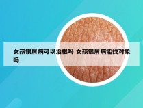 女孩银屑病可以治根吗 女孩银屑病能找对象吗