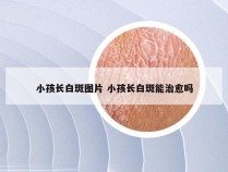 小孩长白斑图片 小孩长白斑能治愈吗