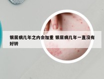 银屑病几年之内会加重 银屑病几年一直没有好转