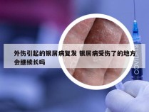 外伤引起的银屑病复发 银屑病受伤了的地方会继续长吗