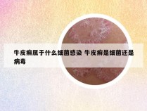 牛皮癣属于什么细菌感染 牛皮癣是细菌还是病毒