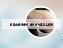 银屑病疼吗痒吗 银屑病疼是怎么回事