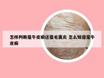 怎样判断是牛皮癣还是毛囊炎 怎么知道是牛皮癣