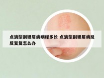 点滴型副银屑病病程多长 点滴型副银屑病反反复复怎么办