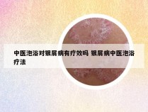 中医泡浴对银屑病有疗效吗 银屑病中医泡浴疗法