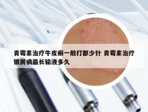 青霉素治疗牛皮癣一般打都少针 青霉素治疗银屑病最长输液多久
