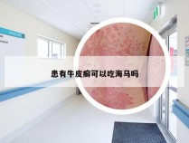 患有牛皮癣可以吃海马吗