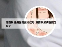 济南银屑病医院预约挂号 济南银屑病医院怎么了