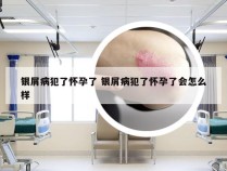 银屑病犯了怀孕了 银屑病犯了怀孕了会怎么样