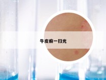 牛皮癣一扫光