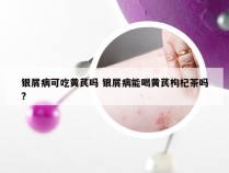 银屑病可吃黄芪吗 银屑病能喝黄芪枸杞茶吗?