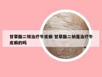 甘草酸二铵治疗牛皮癣 甘草酸二钠是治疗牛皮癣的吗