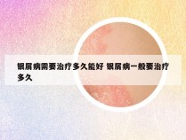 银屑病需要治疗多久能好 银屑病一般要治疗多久