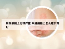 银屑病腿上比较严重 银屑病腿上怎么这么难好