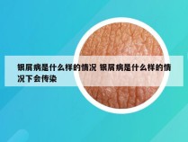 银屑病是什么样的情况 银屑病是什么样的情况下会传染