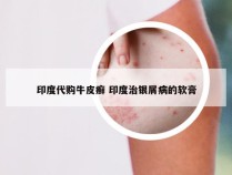 印度代购牛皮癣 印度治银屑病的软膏