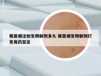 银屑病注射生物制剂多久 银屑病生物制剂打完用药禁忌