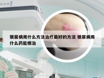 银屑病用什么方法治疗最好的方法 银屑病用什么药能根治