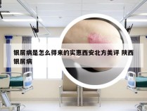 银屑病是怎么得来的实惠西安北方美评 陕西银屑病