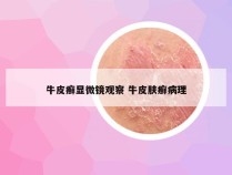牛皮癣显微镜观察 牛皮肤癣病理