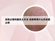 皮肤止痒的最快土方法 皮肤痒用什么药杀菌止痒
