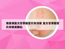 银屑病复方甘草酸苷片和消银 复方甘草酸苷片和银屑颗粒