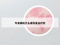 牛皮癣吃什么维生素治疗好
