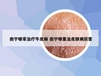 南宁哪家治疗牛皮癣 南宁哪里治皮肤病厉害