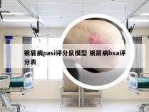 银屑病pasi评分鼠模型 银屑病bsa评分表