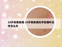 16岁有银屑病 16岁银屑病吃甲氨蝶呤无效怎么办