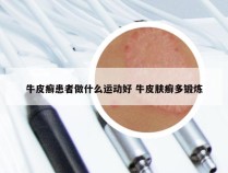 牛皮癣患者做什么运动好 牛皮肤癣多锻炼