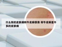 什么样的皮肤病和牛皮癣很像 和牛皮癣差不多的皮肤病