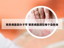 银屑病基因分子学 银屑病基因在哪个染色体