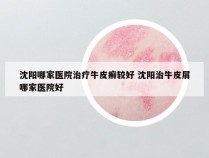 沈阳哪家医院治疗牛皮癣较好 沈阳治牛皮屑哪家医院好