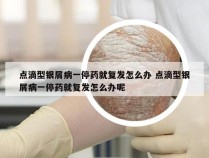 点滴型银屑病一停药就复发怎么办 点滴型银屑病一停药就复发怎么办呢