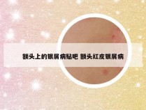 额头上的银屑病贴吧 额头红皮银屑病