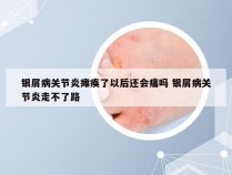 银屑病关节炎瘫痪了以后还会痛吗 银屑病关节炎走不了路