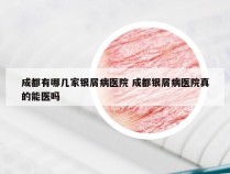 成都有哪几家银屑病医院 成都银屑病医院真的能医吗