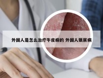外国人是怎么治疗牛皮癣的 外国人银屑病