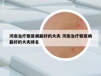河南治疗银屑病最好的大夫 河南治疗银屑病最好的大夫排名