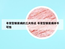 寻常型银屑病的三大特点 寻常型银屑病并不可怕