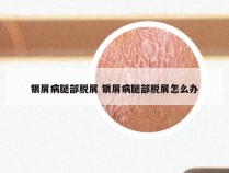 银屑病腿部脱屑 银屑病腿部脱屑怎么办