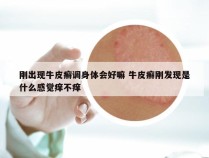 刚出现牛皮癣调身体会好嘛 牛皮癣刚发现是什么感觉痒不痒