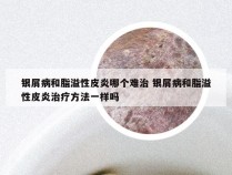 银屑病和脂溢性皮炎哪个难治 银屑病和脂溢性皮炎治疗方法一样吗