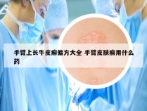 手臂上长牛皮癣偏方大全 手臂皮肤癣用什么药