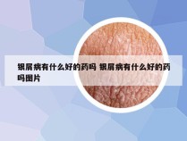 银屑病有什么好的药吗 银屑病有什么好的药吗图片
