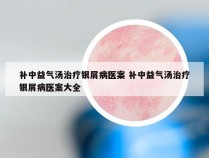 补中益气汤治疗银屑病医案 补中益气汤治疗银屑病医案大全